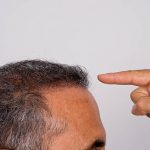 hair transplant